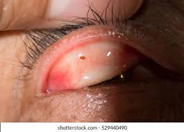 Image result for Conjunctival Foreign Body