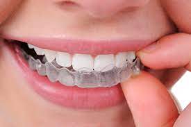 'invisalign uses nearly invisible braces to straighten your teeth. How Much Does Invisalign Cost In The Uk The Dental Guide