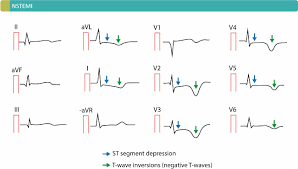 Type 2 has been reported up to 25% of cases of mi depending on the population studied. Nstemi Non St Elevation Myocardial Infarction Unstable Angina Diagnosis Criteria Ecg Management Ecg Echo