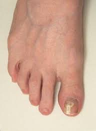 Tau Topics The Efficacy Of Vinegar And Hydrogen Peroxide In Treating Toenail Fungus