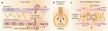 Recovered in the proliferative stage. Alveolar Cells Under Mechanical Stressed Niche Critical Contributors To Pulmonary Fibrosis Molecular Medicine Full Text