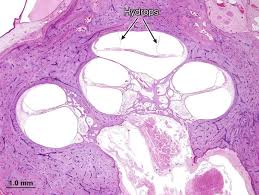 Image result for Bacterial Labyrinthitis
