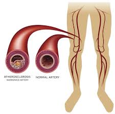 New Technologies For The Treatment Of Peripheral Artery Disease Cadth Issues In Emerging Health Technologies Ncbi Bookshelf