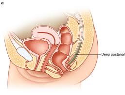 Image result for Ischiorectal Abscess