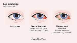 Image result for Allergic Conjunctivitis