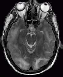 Posterior Reversible Encephalopathy Syndrome Wikem