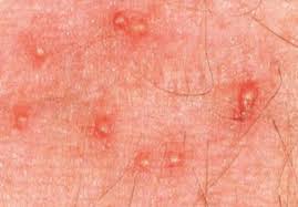 Image result for mite bites on humans