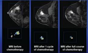 Calcifications are tiny flecks of calcium — like grains of salt — in the soft tissue of the breast that can sometimes indicate the presence of an early breast cancer. Breast Cancer Research Interest Group Ucsf Radiology