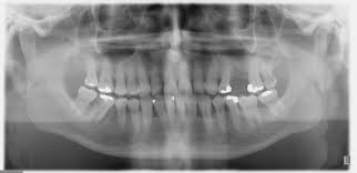 Image result for Periodontal Abscess