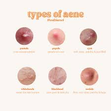 Image result for Pustule