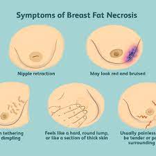 Breast Fat Necrosis Symptoms Causes Diagnosis And Treatment