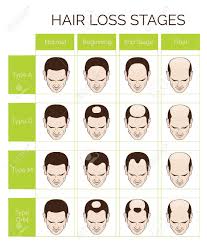 Information Chart Of Hair Loss Stages And Types Of Baldness Illustrated