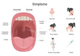 În acest articol, vă vom explica care sunt cauzele inflamării ganglionilor limfatici. Faringita Streptococica Cauze Simptome Tratament