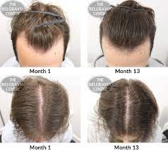 The problem seems to be a lack of understanding about the difference between cbd oil and hemp seed oil. Hair Growth Success Belgravia S Treatment Is A Good Option