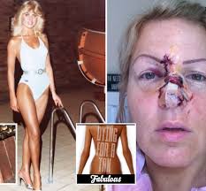 Susanna Hancock reveals addiction to sunbeds in her 20s left her with skin  cancer