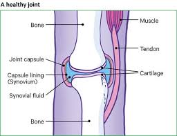 Femur—long bone of the thigh and longest bone in the body; Arthritis Causes Symptoms Treatment Versus Arthritis