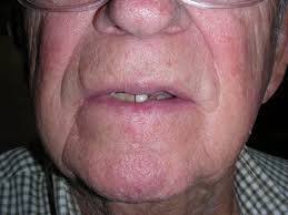 Cases usually occur on the lower lip, since it receives more sun exposure—the leading cause of lip cancers. Before And After Mohs Surgery Squamous Cell Carcinoma Photos