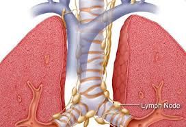 The diagnosis of lung cancer is confirmed through biopsy by bronchoscopy. Lung Cancer Early Signs Symptoms Stages