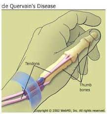 Acupuncture Alternative For De Quervains Syndrome Alameda Acupuncture Dr John Nieters L Ac Dr Jenny Nieters L Ac Alameda Ca