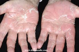 It could likewise suggest a hidden condition. Peeling Skin Syndrome Definition Treatment And Prevention