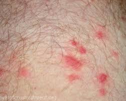 Similar to wigger which is a white person who thinks they are or act like they are black. Chiggers Jiggers Red Bugs Treatment How To Get Rid Of Treat Chiggers Domyown Com