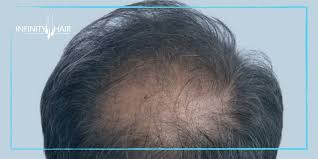 زراعة الشعر في اسطنبول كيفية اختيار أفضل مركز زراعة شعر في إسطنبول