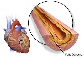 The terms heart attack and cardiac arrest are often used interchangeably. Coronary Artery Disease Wikipedia