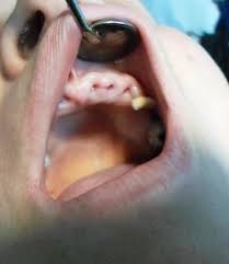 Grigsby asked that his wife come to the treatment room where they discussed the options. Postoperative View Of The First Extraction Site After Five Weeks Teeth Download Scientific Diagram