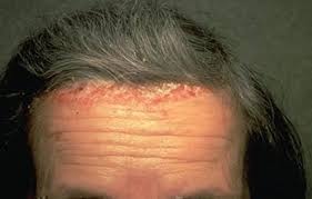 Scalp psoriasis is undoubtedly one of the most common type of psoriasis. Scalp Psoriasis Causes Treatment Options Natural Home Remedies