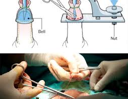 How much does circumcision cost. Circumcision Doctor Dr John Hoover M D Primary Care Physician