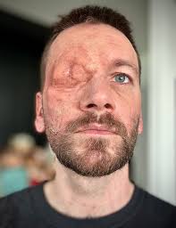 Silicone moulding techniques for prosthetics