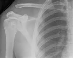 Instead of attaching directly to your sternum, they all attach to your lowest true rib. Trauma Section 3 Postgraduate Orthopaedics