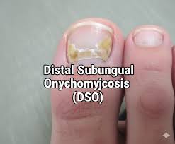 Image result for onychomycosis