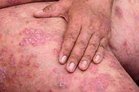 Skin cancer is by far the most common type of cancer. Skin Cancer Checks In Psoriasis