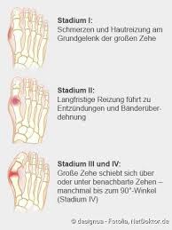 Wann sollte der hallux valgus operiert werden? Hallux Valgus Ursachen Und Behandlung Netdoktor