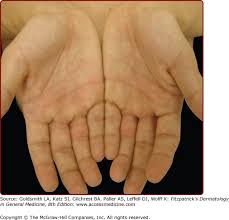 In primary palmar erythema, the person is already born with the genes that make them susceptible to getting it. Skin Changes And Diseases In Pregnancy Plastic Surgery Key