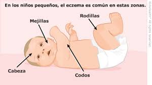 Eccema Dermatitis Atopica Para Padres Nemours Kidshealth