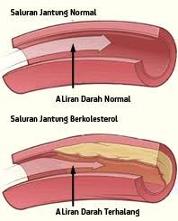 Jadi cukup bilang aja apa keluhan anda dan gak perlu kasi tau dia titik apa yg harus ditusuk. Penawar Kolesterol Clear Herbs