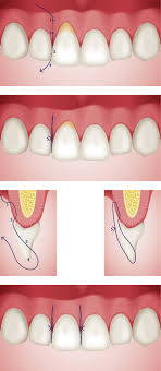 Maybe you would like to learn more about one of these? Modified Vertical Mattress Sutures Download Scientific Diagram