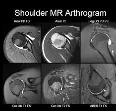 Image result for Shoulder MRI