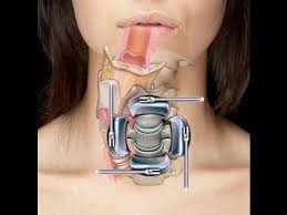 Pin By Fauquier Ent On Videos Neck Surgery Spine Surgery Acdf Surgery