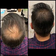 Scalp Micro Pigmentation To Fill In Thinning Areas Hair Loss Men Hair Loss Solutions Micro Scalp Pigmentation
