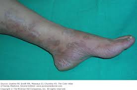 Image result for Tinnea vesiculosa