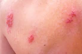 Hiv (human immunodeficiency virus) is a virus that damages the cells in your immune system and weakens your ability while aids cannot be transmitted from 1 person to another, the hiv virus can. Rote Punkte Auf Der Haut Heilpraxis