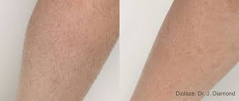 In the previous not many years the neighborhood government has changed the motion of the city making it. Laser Hair Removal Fast Pain Free Solution With Dr Pamela Kulback