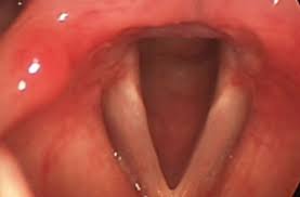 Image result for Reflux Laryngitis