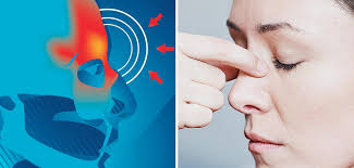 Kommt es zu einer verstärkung der beschwerden im laufe der erkrankung und tritt hohes fieber auf, können bakterien ursache der sinusitis sein oder es ist zu einer zusätzlichen infektion mit bakterien gekommen (sogenannte zweitinfektion). Chronische Sinusitis Entzundete Nebenhohlen Sind Qualendes Volksleiden Welt