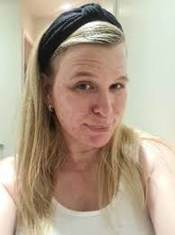 Mum felt “like a monster” and even hid her face from her daughter when she  was struck with cystic acne after having Covid