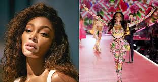 Meet Sonya Charles, A Malaysian Model Bringing Awareness To Vitiligo.