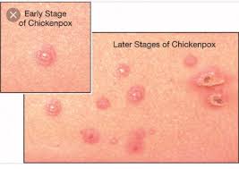 Chickenpox is a highly contagious infection that causes an itchy, spotty rash. Rick Maskdonald Md On Twitter Urgent Care Clinic Docs This Is What Chicken Pox Looks Like Dew Drop On A Rose Petal It Is Rarely Seen Now Misdiagnosis Leads To Chaos In